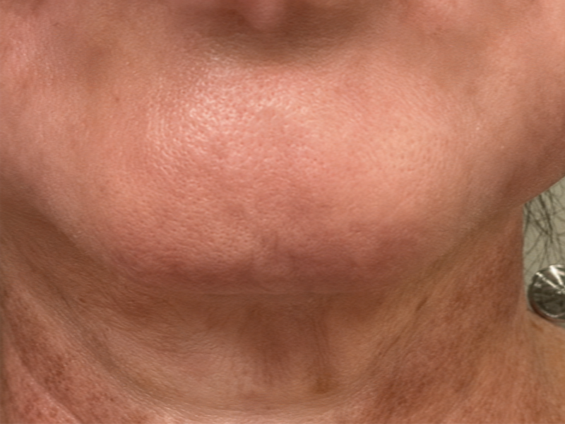 After face and neck LED mask routine for firmer smoother-looking skin