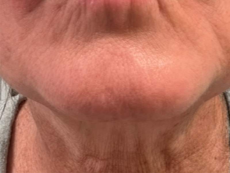 Before red light therapy mask use for loose skin on face and neck