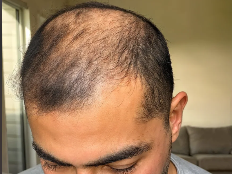 Before using red light therapy hat for thinning crown and visible hair loss care