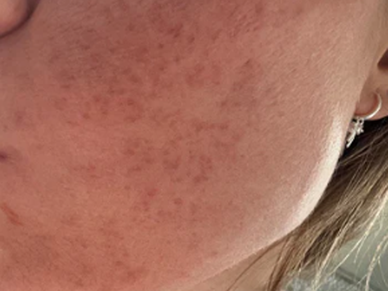 After 5-color LED light therapy panel use for reduced redness and healthier-looking skin