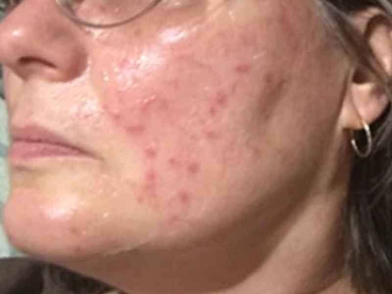 Before LED light therapy panel use for acne marks redness and uneven skin texture