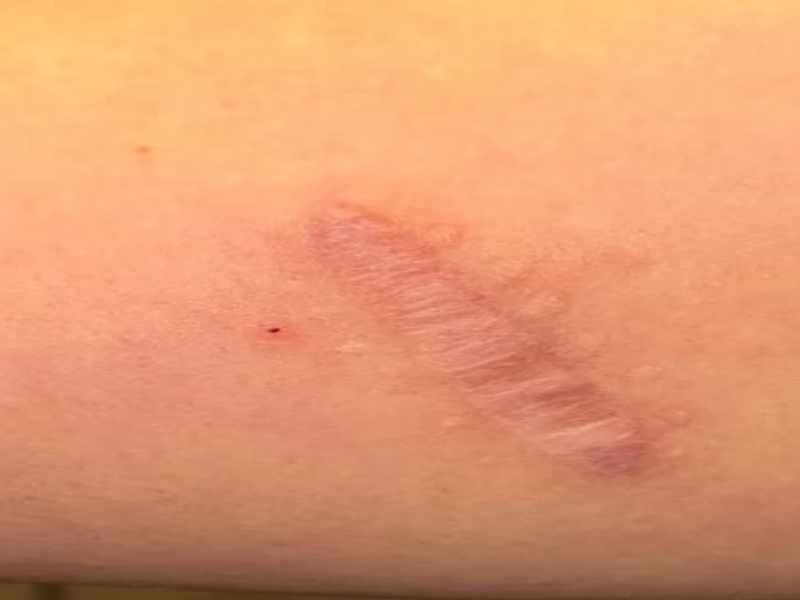 Scar recovery before using LED light therapy panel